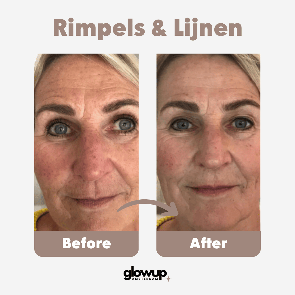 Infrarood LED Lichttherapie Gezichtsmasker GlowUp Amsterdam