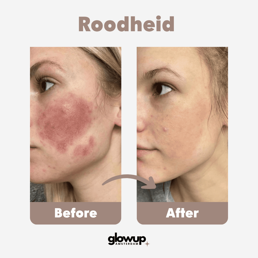Infrarood LED Lichttherapie Gezichtsmasker GlowUp Amsterdam