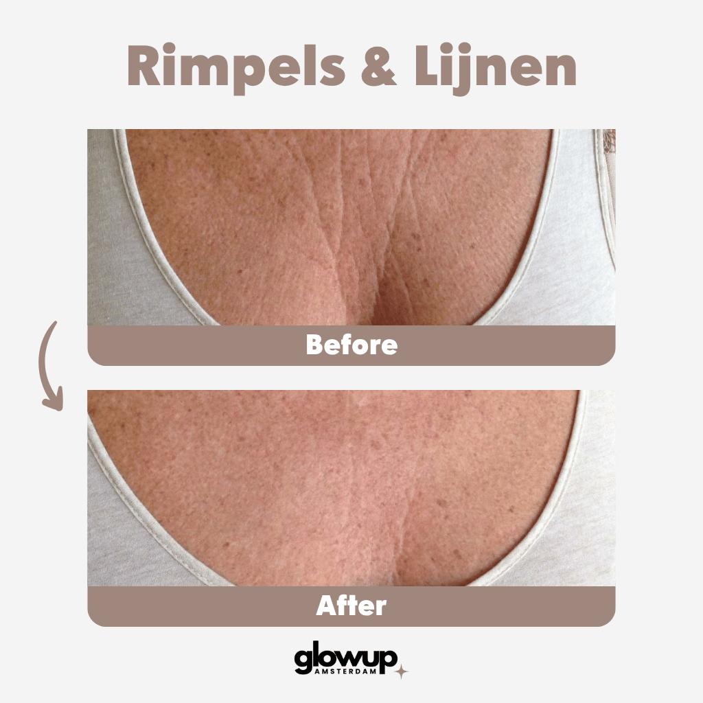 Infrarood LED lichttherapie combi - GlowUp Amsterdam™